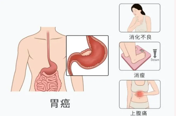 魔高一尺，道高一丈：胃肠镜—消化道早癌克星